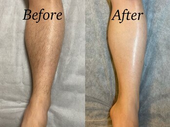 ラジター 江坂(LAZITER)/メンズ脱毛