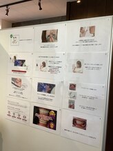 ムーンホワイトニング(Moonホワイトニング)/セルフホワイトニングの説明