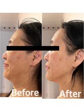 ラキネイ 目黒(Lakinei)/たるみ改善&毛穴ケア小顔セット