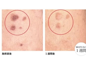 ヴィゴラス/シミケア