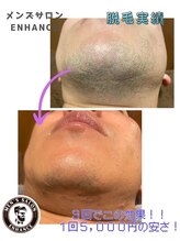 エンハンス 亀有(enhance)/メンズヒゲ脱毛でいい男に！