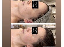 【小顔×たまご肌コース】もち肌×小顔×体の凝りを同時にケア