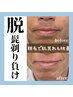 【メンズ全顔脱毛】毛穴レスなお肌へ　¥11000→¥6600