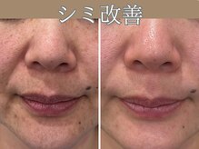 ハウオリ(HAUOLI)/シミ悩みに