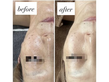 デュモンド(dumonde)/60代OO様の変化