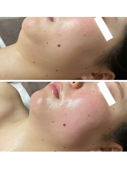 武蔵小杉リンパサロン かおりの部屋/小顔筋膜リリース+二重顎改善