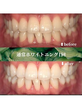フタバ 天神大名店(futaba)/初回ホワイトニングbefore after