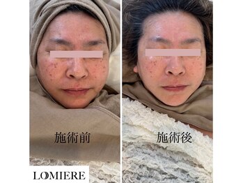 ロミエール 南草津店(LOMIERE)/セルマン★艶玉肌♪