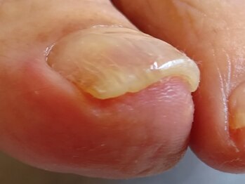 重く痛い巻き爪も一回でここまで