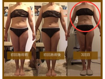 サロンドボーテ ヴィクトワール マルヤマ(Salon de beaute VICTOIRE MARUYAMA)/50代・キャビテーション・週1回