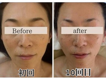 ミピマムマール(Mipimam Maaru)/お客様before→after