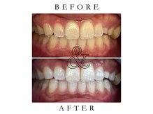 ジュエルホワイトニング/ホワイトニングビフォーアフター