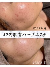 サロン ド エン(Salon de. en)/ニキビケア◇ハーブピーリング