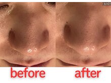 ホッコリ 段原店(HOKKORI)/毛穴洗浄でツルツル肌