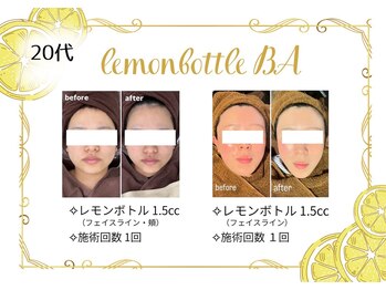 アヤエステティックサロン 綱島店(AYA)/大人気のレモンボトルで小顔