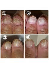 ティアラネイル 宇都宮/深爪矯正