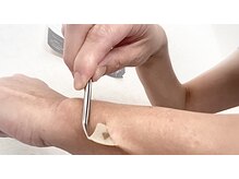 お顔も体も、女性も男性もOKです。シミの悩みにサヨナラです！