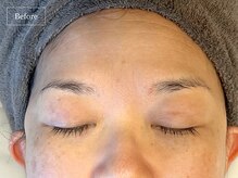 キュレイテッドスキン(CURATED SKIN)/ピーリング/毛穴ケア/肌質改善