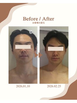 ビーキュート 学芸大学店(BE-CUTE)/Before/After 施術