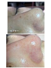 リンカ(Rinca)/毛穴エクストラクション