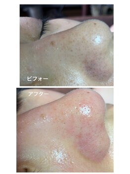 リンカ(Rinca)/毛穴エクストラクション