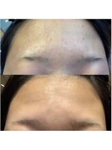 ブランシェ 金沢店 × 椿/リアージュセラム使用前後