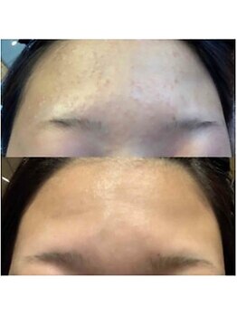 ブランシェ 金沢店 × 椿/リアージュセラム使用前後