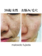マロウド 藤枝店(malowdo)/短期集中/毛穴、たるみケア