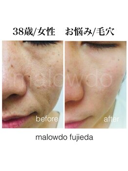 マロウド 藤枝店(malowdo)/短期集中/毛穴、たるみケア