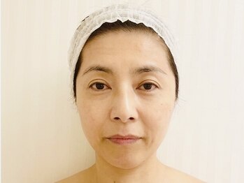 エスツリービューティーアンドネイル(S-TREE BEAUTY&NAIL)/【年齢肌】ビフォー