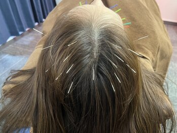 つばさはりきゅう院の写真/《【毛髪ケア】育毛促進鍼+ヘッドスパ》メディア話題の育毛促進鍼◎最近髪に元気がないと感じる方へ