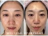 50代のシミしわタルミ改善【高濃度30%エクソソーム施術6回×韓国コスメ一式】