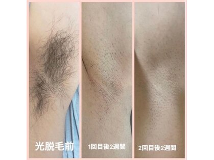 顔脱毛×艶肌フェイシャルエステ【VIO・ヒゲ】レミュールひたちなか の写真