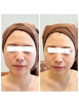 デジール(DESIR)/最強小顔menu☆筋膜層アプローチ