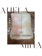 アーネラミーナ(Anela mina)/施術例