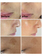 クリスタルボウ(Crystal BEAU)/Elight顔脱毛1回のみ