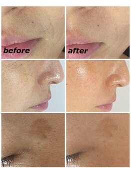 クリスタルボウ(Crystal BEAU)/Elight顔脱毛1回のみ