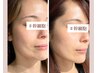 【ほうれい線とさらば!!】徹底ケアコース体験 ¥22,000→¥8,800