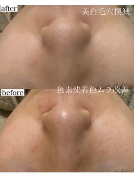 モンクラッシー(Mon classy)/イラストリアス色ムラ改善