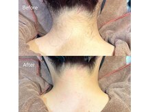 初めてのWAX脱毛お任せください♪VIO,顔,ボディまで幅広く対応