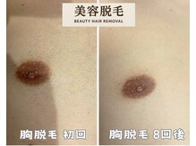 シエルエトワール 唐津店(Ciel Etoile)/美容脱毛　胸脱毛