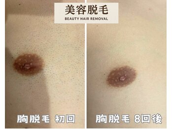 シエルエトワール 唐津店(Ciel Etoile)/美容脱毛 胸脱毛