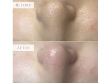 ユニ(uni.)/毛穴エクストラクション症例