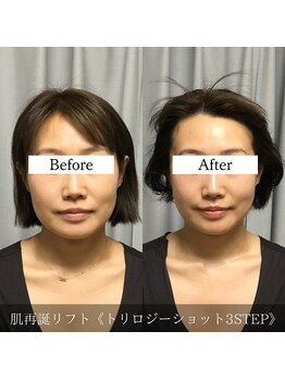 ブリリオプラス 四条烏丸店(Brillio plus)/肌再誕リフト3step