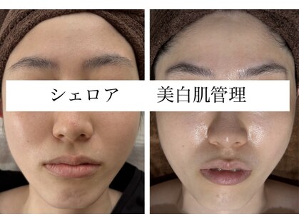 シェロア【美白フェイシャル/毛穴/小顔/マッサージ/肌管理】の写真