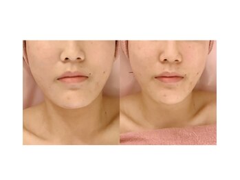 小顔美肌コルギ専門店 センティード 吉祥寺(Sentido)/施術写真