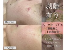 ベガ(Vega)の雰囲気（気になるニキビ肌にアプローチ！ハーブピーリングでなめらか素肌）