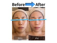 ラシェリー(La Cherie)/ビフォーアフター