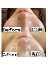 サマラボ 笹塚店(Sama Labo)/肌質改善