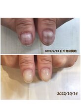 ウェリナ(welina)/自爪育成　半年